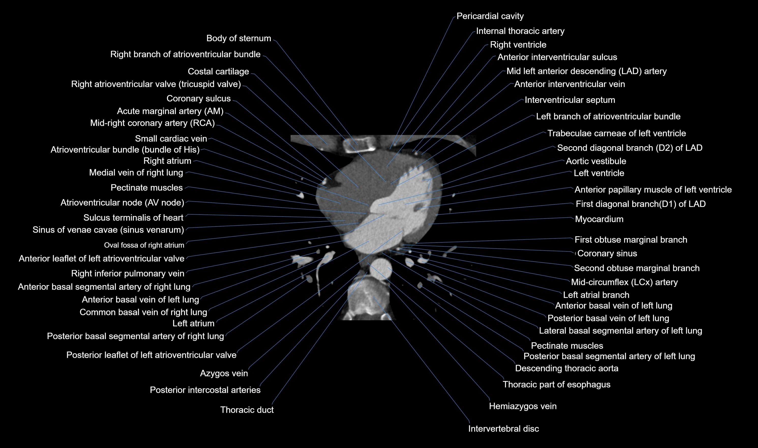 CT heart (coronary angiogram) axial view cross sectional anatomy labelled radiology image-00039.webp